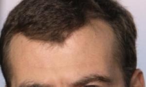 Perhatian terhadap Detail: Selebritis yang Mengubah Garis Rambutnya Menaikkan Garis Rambut Anda